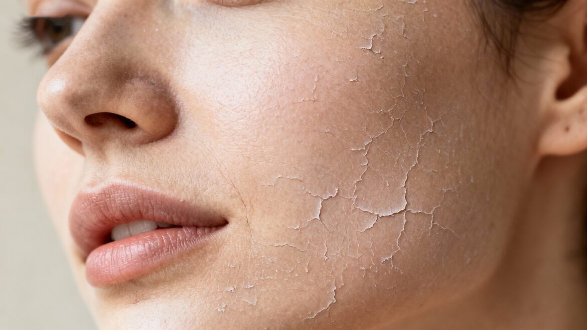 Dry skin explained with causes and skincare needs